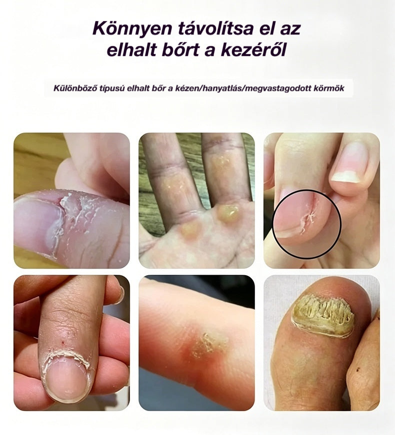 💅👍 Elektromos körömreszelő az onychomycosis kezelésére